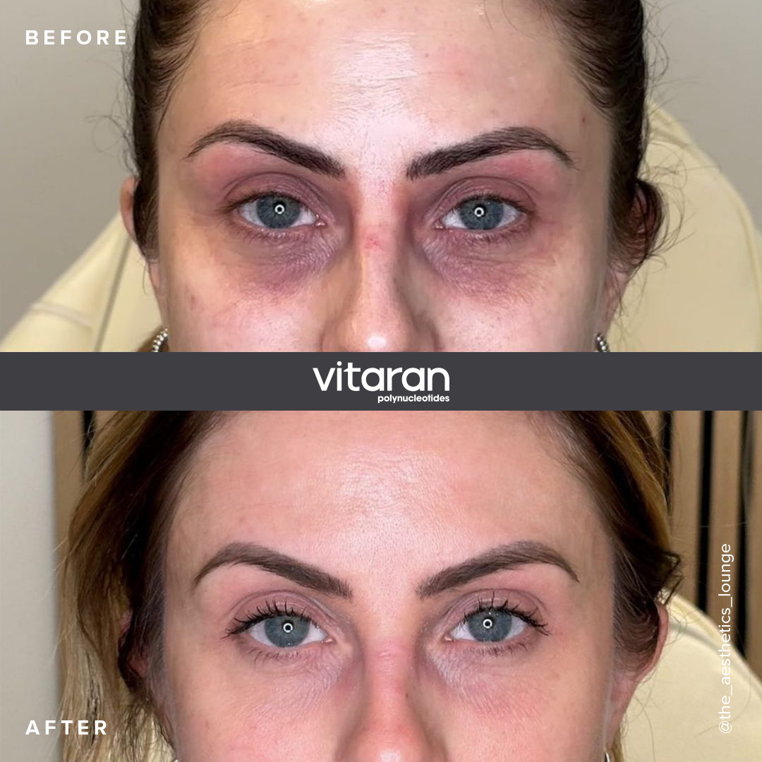VITARAN Eyes before and after image of woman's under yes