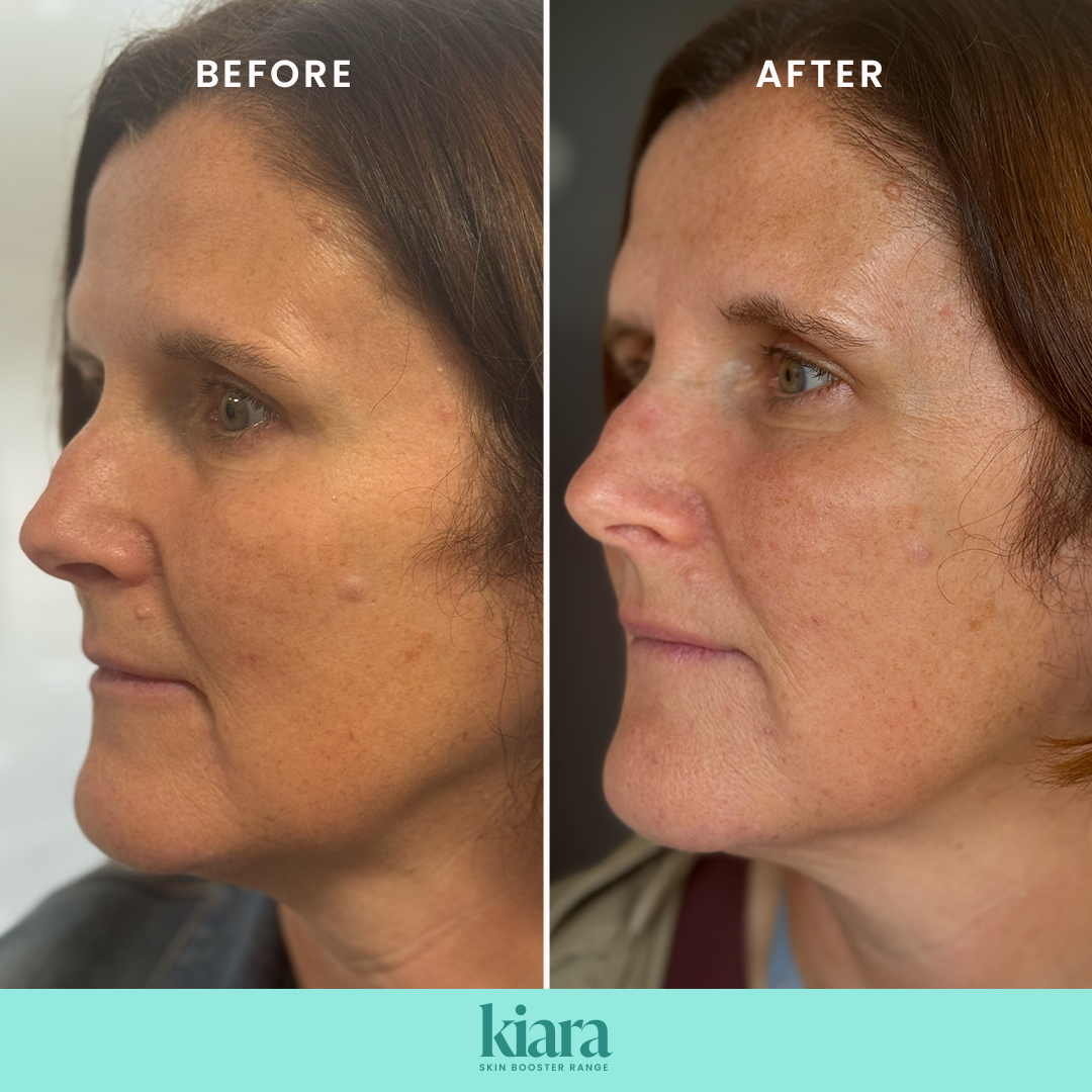 Kiara and Kiara Reju before and after results