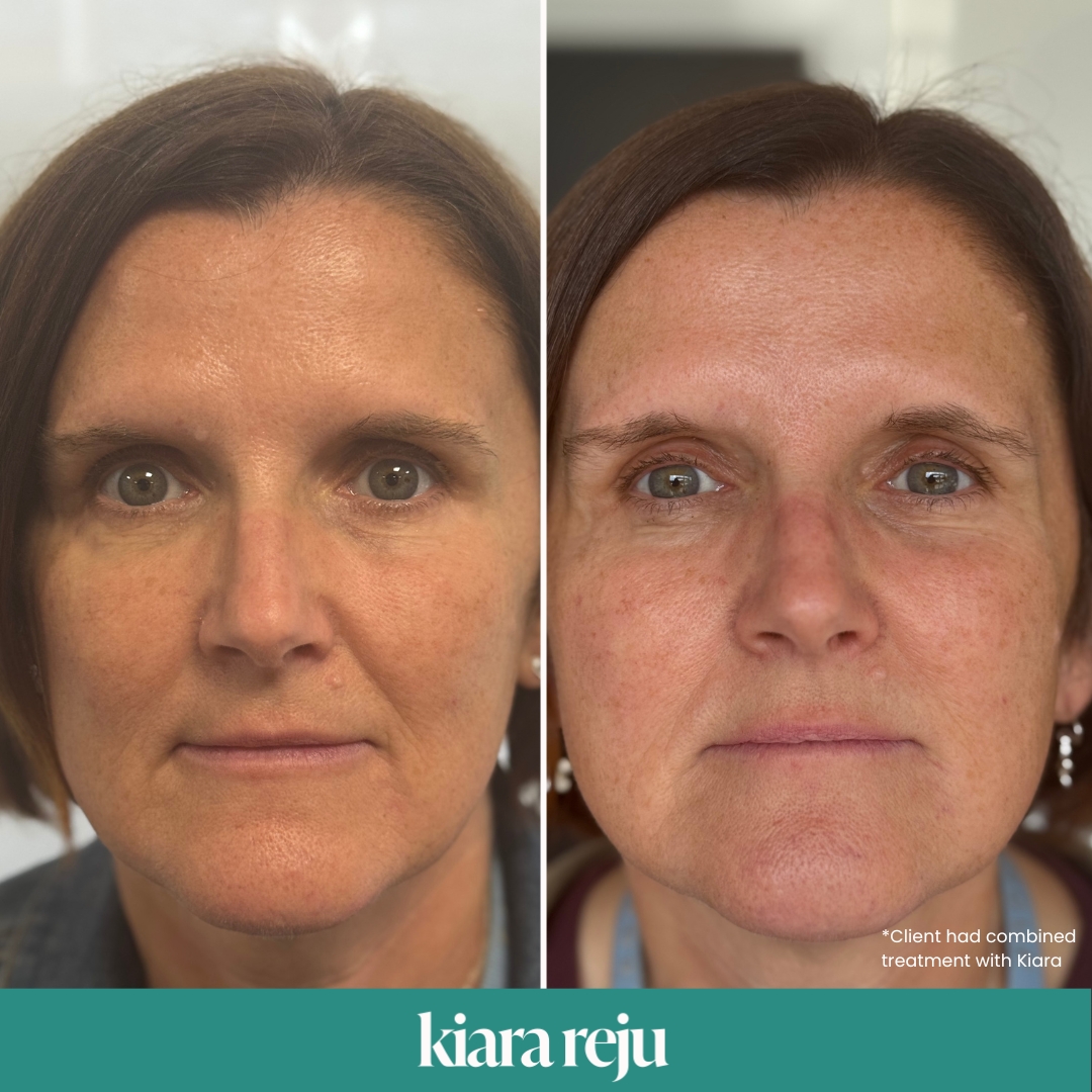 Kiara Reju and Kiara skin booster before and after image