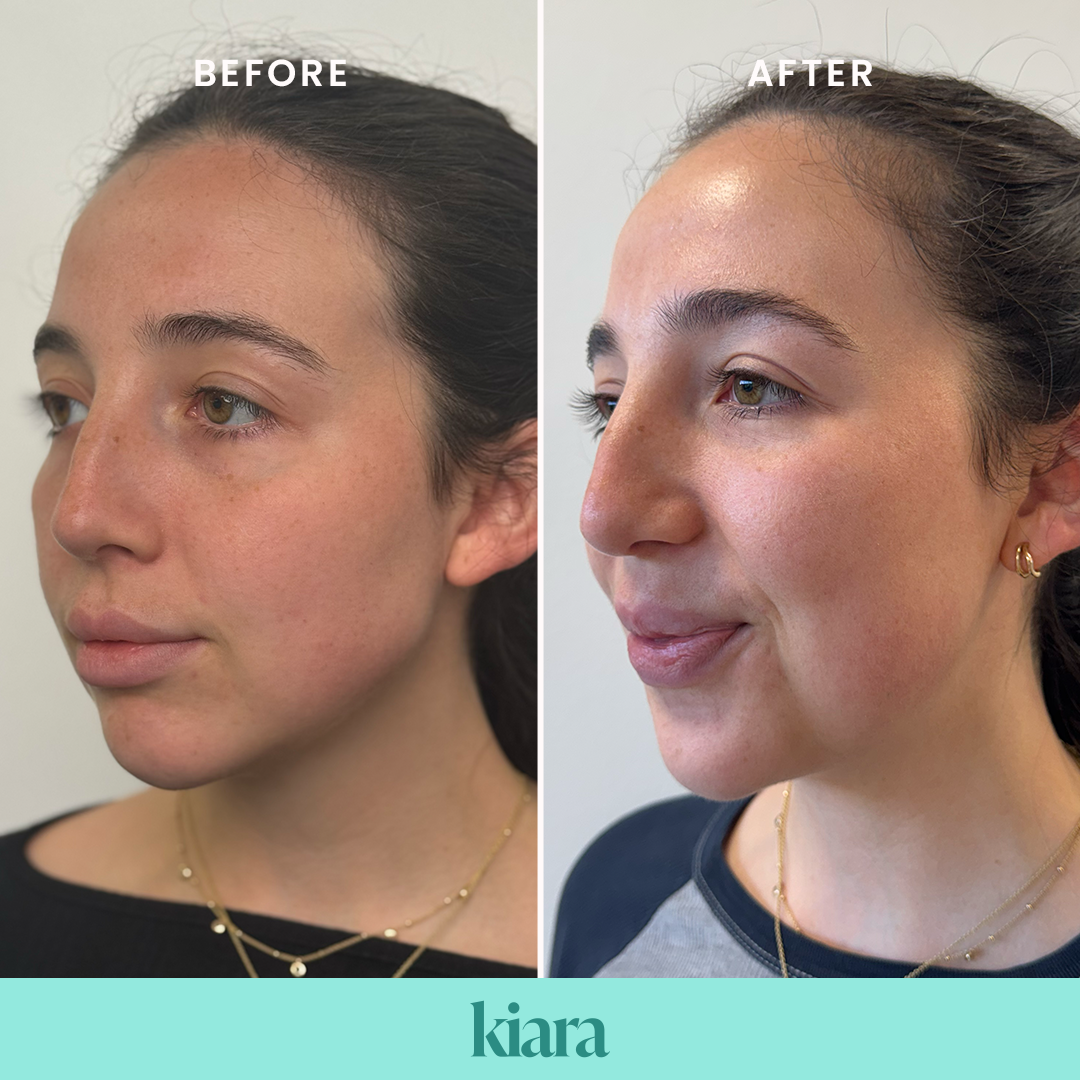 Kiara skin booster before and after image
